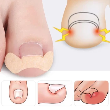 20pcs Коректор за лак за нокти на краката, помощ за отстраняване на врастнали нокти на краката, стикер за нокти